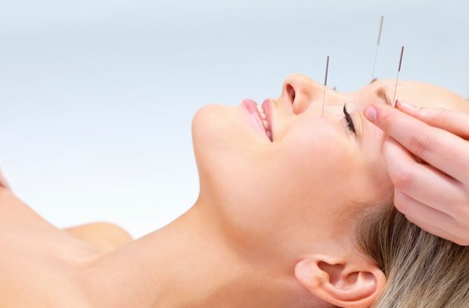 Acupuntura Facial
